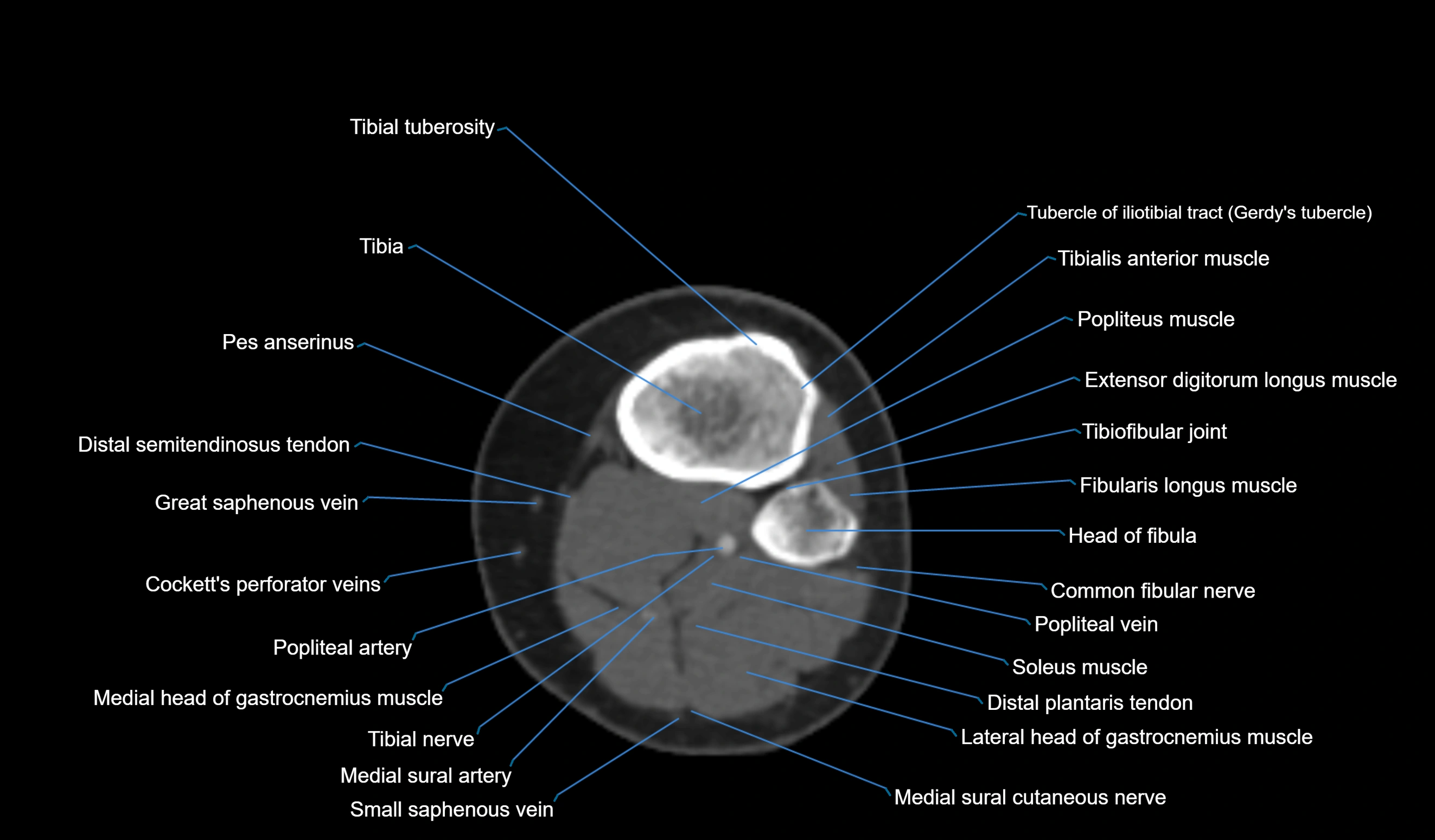 CT knee axial cross sectional anatomy labelled image-00047.webp